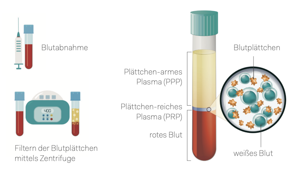 PRP – plättchenreiches Plasma – der Weg vom Vollblut zum heilsamen PRP – BODYFORCE Longevity Center – PRP Zentrum Wien