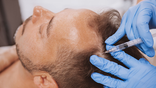 Close up of a mature man receiving hairloss treatment injections in scalp by professional trichologist. Dermatologist doing scalp injections for mature male client with alopecia problem